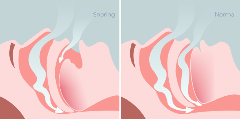 does-your-partner-snore-long-term-health-effects-of-snoring