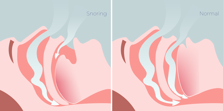 Snoring compared to normal